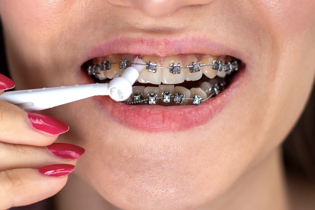 Dental-Irrigator und Zahnspange: So reinigst du deine Zähne effektiv trotz Brackets